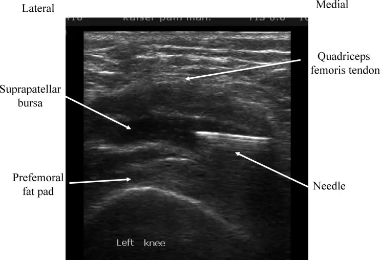 A picture of the left knee area in an ultrasound.