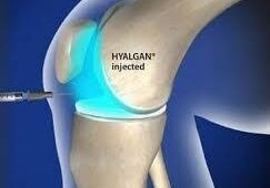 A picture of an artificial joint with hyalgan injected.